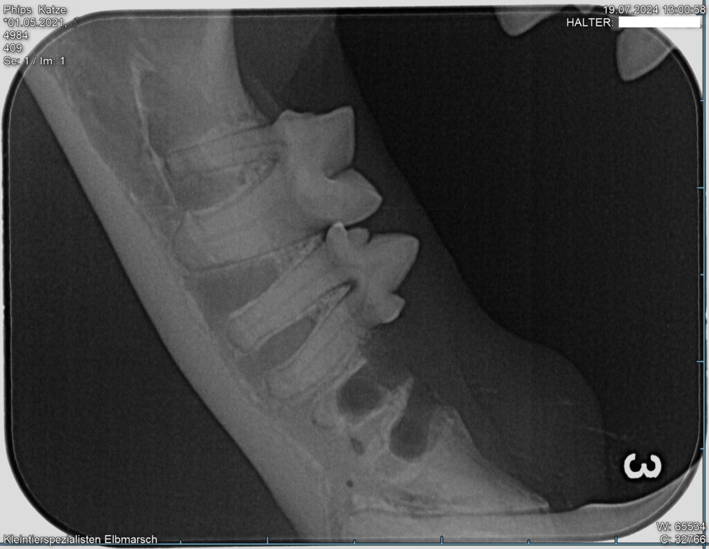 Röntgenbild vom Unterkiefer. Ein Zahn fehlt komplett, zwei weitere sind noch drin